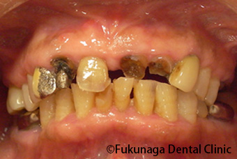 テレスコープの入れ歯と、通常のバネの着いている入れ歯の違い