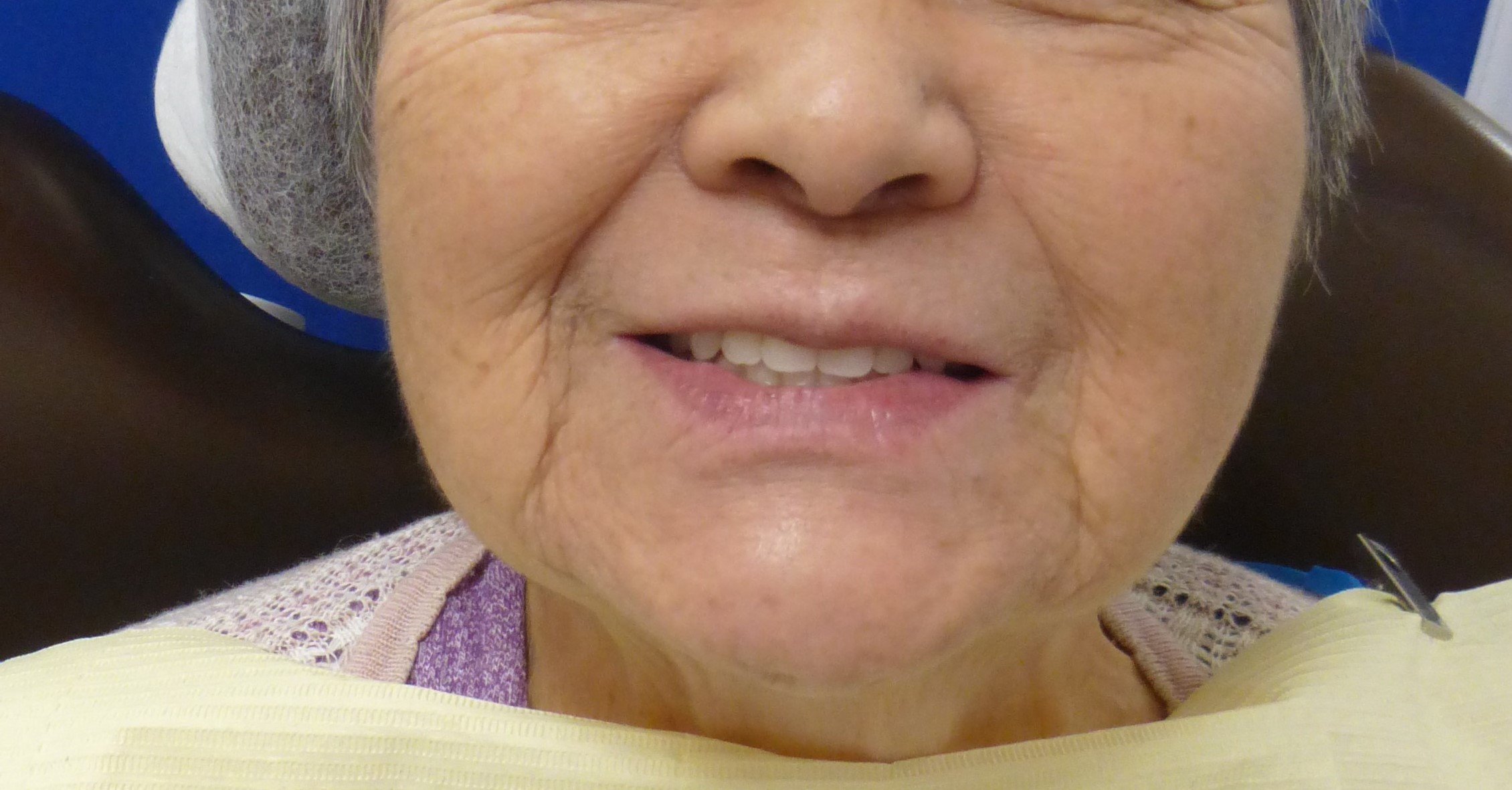 総入れ歯をあきらめない ～80代女性の総入れ歯治療事例～ - 埼玉