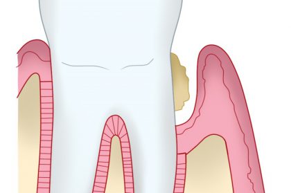予防歯科で意識したい歯石のケアについて