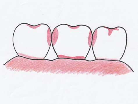 歯の3大不潔域