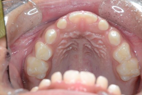 前歯が前に出てしまう、いわゆる出っ歯の状態