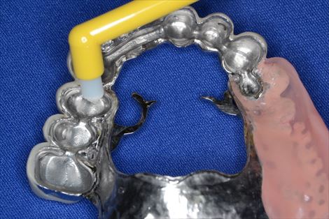 入れ歯の内冠にはタフトブラシを使う