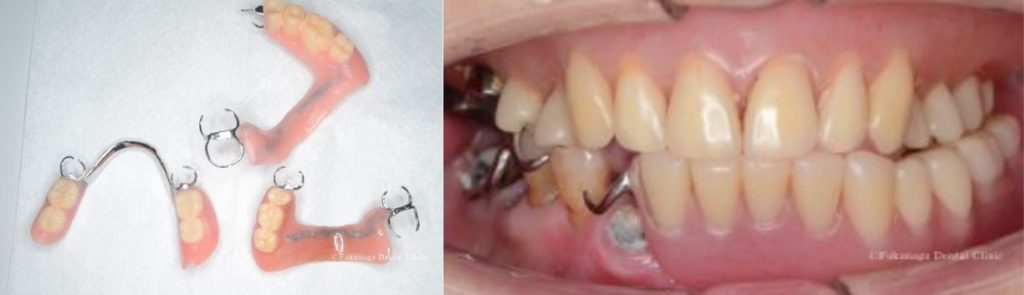 保険の義歯は、バネで残りの歯が引き抜かれてしまう