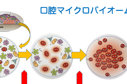 歯のクリーニング、ただのお掃除じゃないんです　～マイクロバイアルシフトへの対策としてのクリーニング～